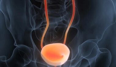 Blocking mir-21 shows promise for slowing bladder cancer growth