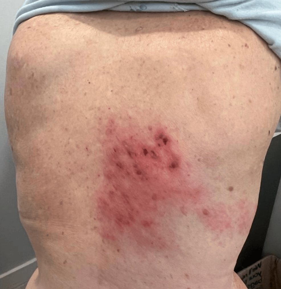 Myocarditis Associated With Herpes Zoster in a 91-Year-Old Woman: A Rare Cardiac Complication With Favorable Outcomes