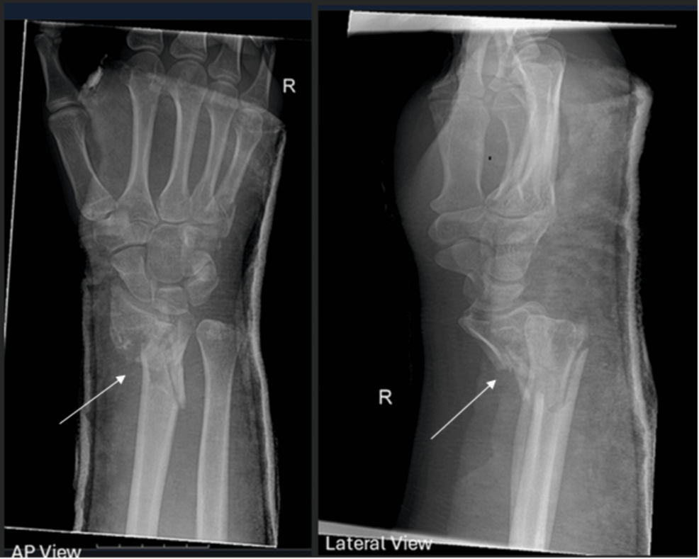 Unmasking Compartment Syndrome in an Autistic Adolescent: A Case of Median Nerve Compression Following Distal Radius Open Reduction and Internal Fixation (ORIF)