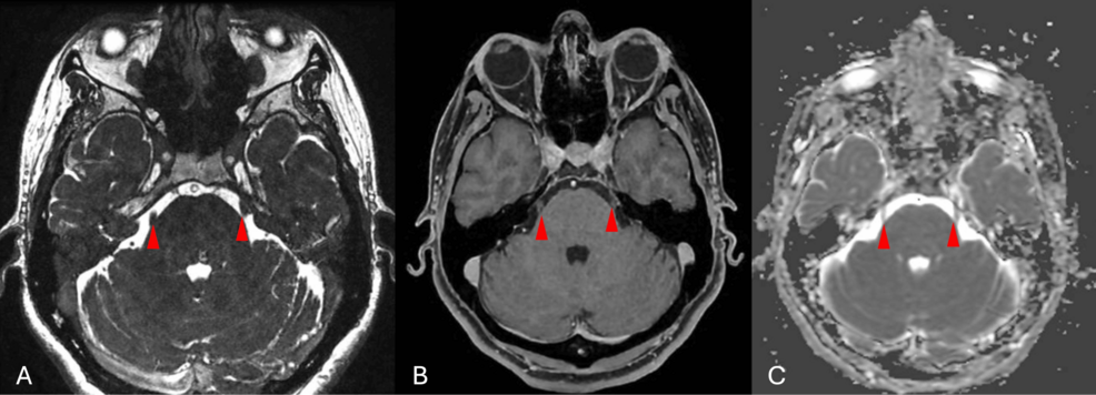 Facial Pain Mimicking Trigeminal Neuralgia Secondary to Low-Cervical Spondylosis: A Case Report and Comprehensive Literature Review