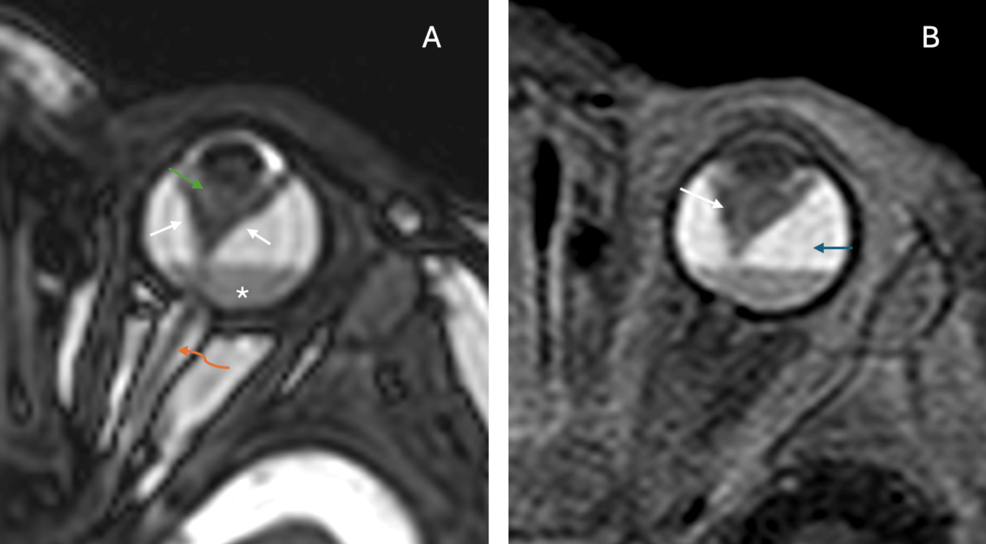 Persistent Hyperplastic Primary Vitreous With Complete Retinal Detachment in an Infant: Imaging Characteristics and Clinical Management