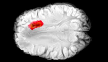 This Common Drug Seems to Fight One of The Deadliest Brain Cancers : ScienceAlert