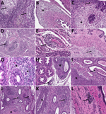 Histopathologic findings in reproductive tissues of strain 13/N guinea pigs with lethal disease after Lassa virus (LASV) strain Josiah infection in study of guinea pig model for LASV infection of reproductive tract and considerations for sexual and vertical transmission. Panels A–F depict samples from female guinea pigs; panels G–L depict samples from male guinea pigs. A) Ovary (25 days postinfection [dpi]) with moderate perivascular and interstitial inflammation (arrows). B) Oviduct (20 dpi) with focal interstitial inflammation and edema (asterisk) within the serosa. C) Uterus (23 dpi) with mild endometrial inflammation and edema (asterisk) and hemosiderin-laden macrophages (arrow). D) Uterus (25 dpi) with multifocal mononuclear inflammatory cells (arrow) forming partial cuffs around vessels in the myometrium. E) Uterine vessel (23 dpi) with mural infiltration by lymphocytes and plasma cells (arrow). F) Cervix (23 dpi) with multifocal, mild, perivascular inflammation (arrow). G) Epididymis (26 dpi) with moderate perivascular inflammation (asterisks). H) Epididymis (23 dpi) with multifocal interstitial inflammation around tubules (asterisk) and a vessel (arrow). I) Epididymis (26 dpi) with marked epididymitis with tubular dilation by inflammatory cells (arrow) and rupture, associated with sperm granuloma formation (asterisk). J) Epididymis (23 dpi) with marked epididymitis, with interstitial inflammation (arrows), and intratubular heterophils associated with rupture and granuloma formation (asterisk). K) Epididymis (26 dpi) with marked interstitial inflammation (arrow) and tubular epithelial necrosis with heterophils (asterisk). L) Prostate (23 dpi) with mild focal lymphocytic, perivascular inflammation (arrow). Hemotoxylin and eosin stain. Original magnifications ×20 (panels A, E, G, I, K), ×15 (panels B, H), and ×10 (panels C, D, F, J, L).