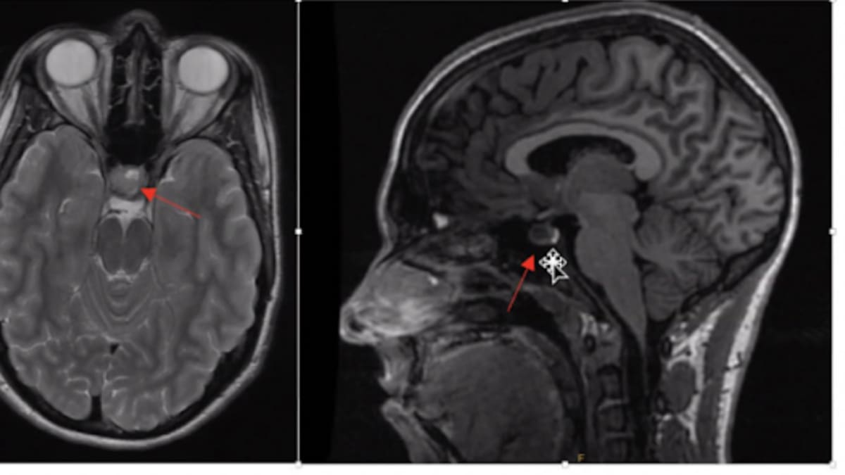 Medical Mysteries: For years she was told it was stress – a brain scan revealed the real cause