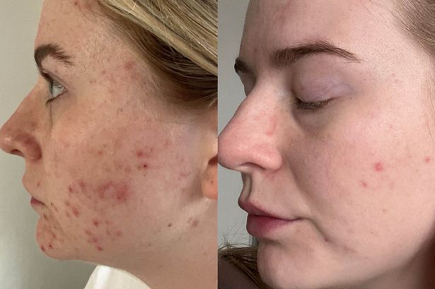 A customer before and after using the 47 Skin products.