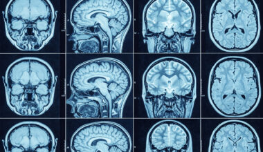 Anavex pushes for Alzheimer’s drug re-evaluation