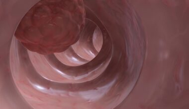 Integrating AI into colon cancer diagnosis improves the speed and accuracy of detection