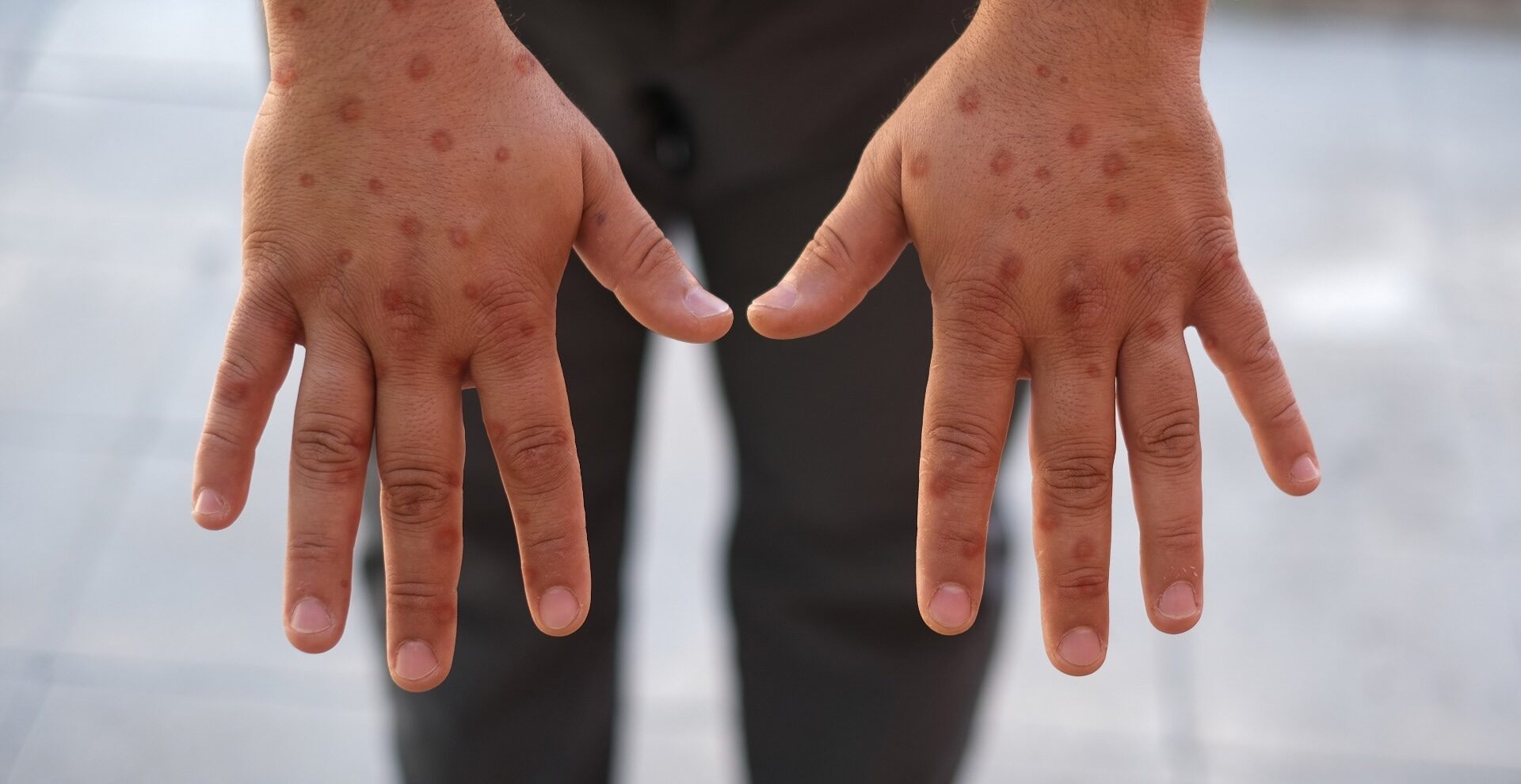 Study: The Incubation Periods of Mpox Virus Clade Ib. Image Credit: Selman GEDIK /  Shutterstock