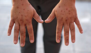 Study: The Incubation Periods of Mpox Virus Clade Ib. Image Credit: Selman GEDIK /  Shutterstock