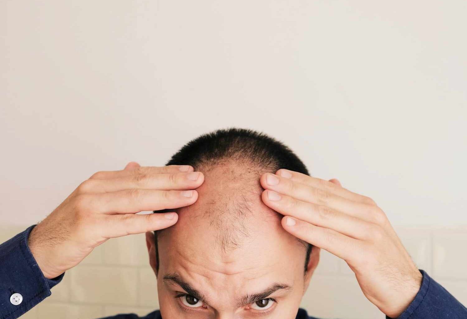 Is this the end of baldness? This stock jumps 50% on breakthrough