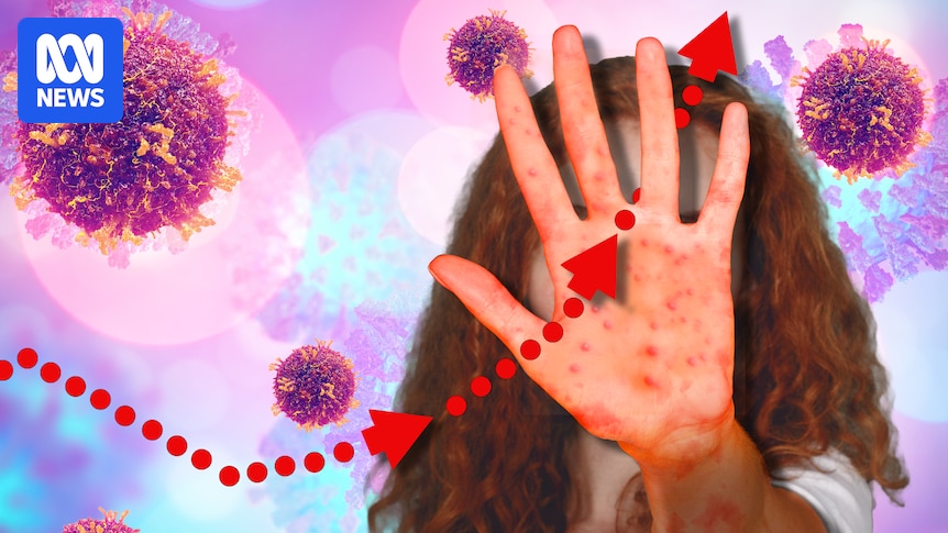 Measles cases almost triple in Australia as global outbreaks continue