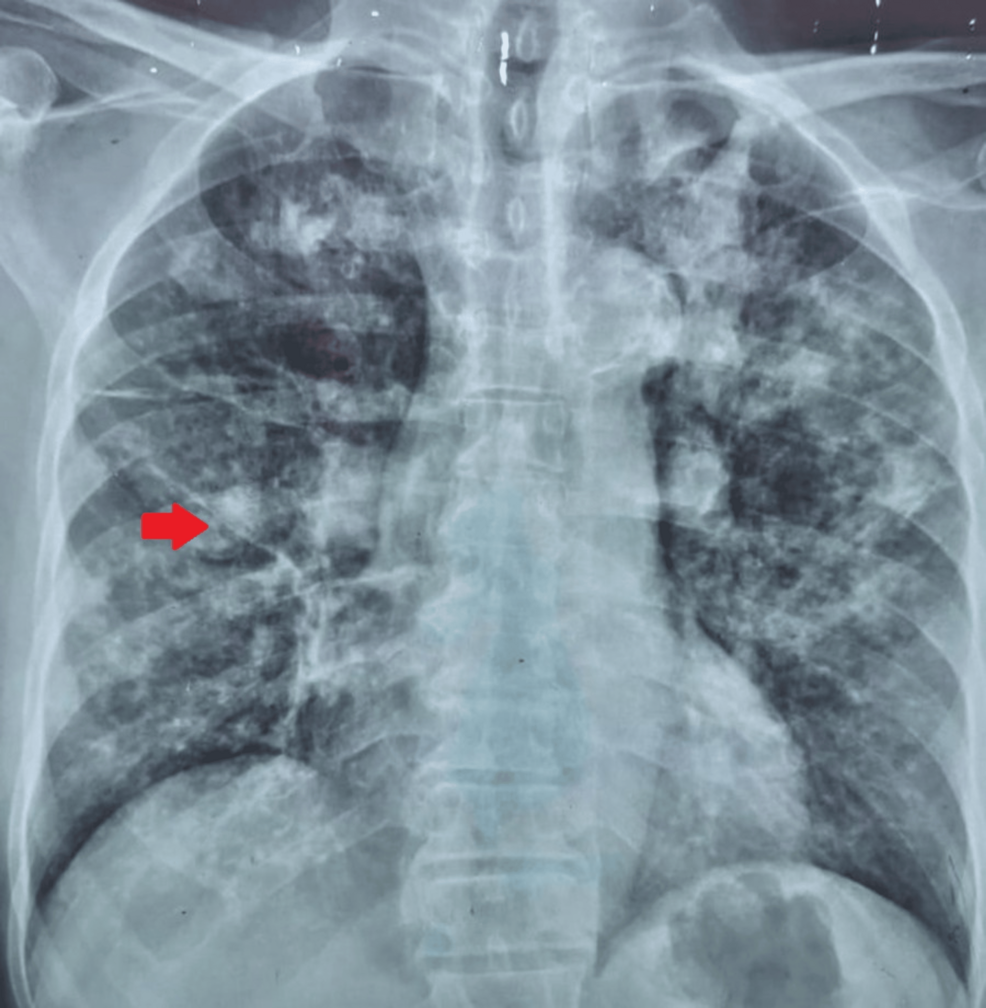 Unmasking Invasive Pulmonary Aspergillosis: Insights From a Case Series at a Tertiary Care Center