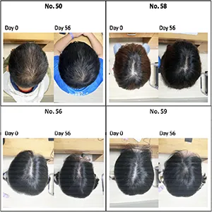 Representative photographs of the participants in Group E on Day 0 and Day 56 after treatment. Credit: medRxiv
