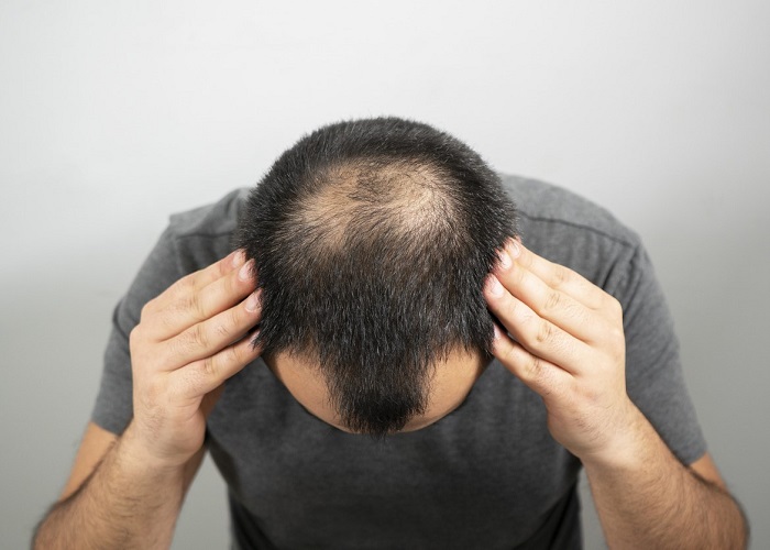 Hair-loss drug boosts hair growth by 539% – Irish study