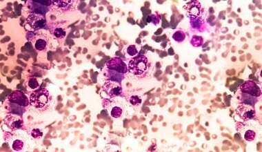 Antibody Therapy Eradicates Traces of Multiple Myeloma in Preliminary Trial