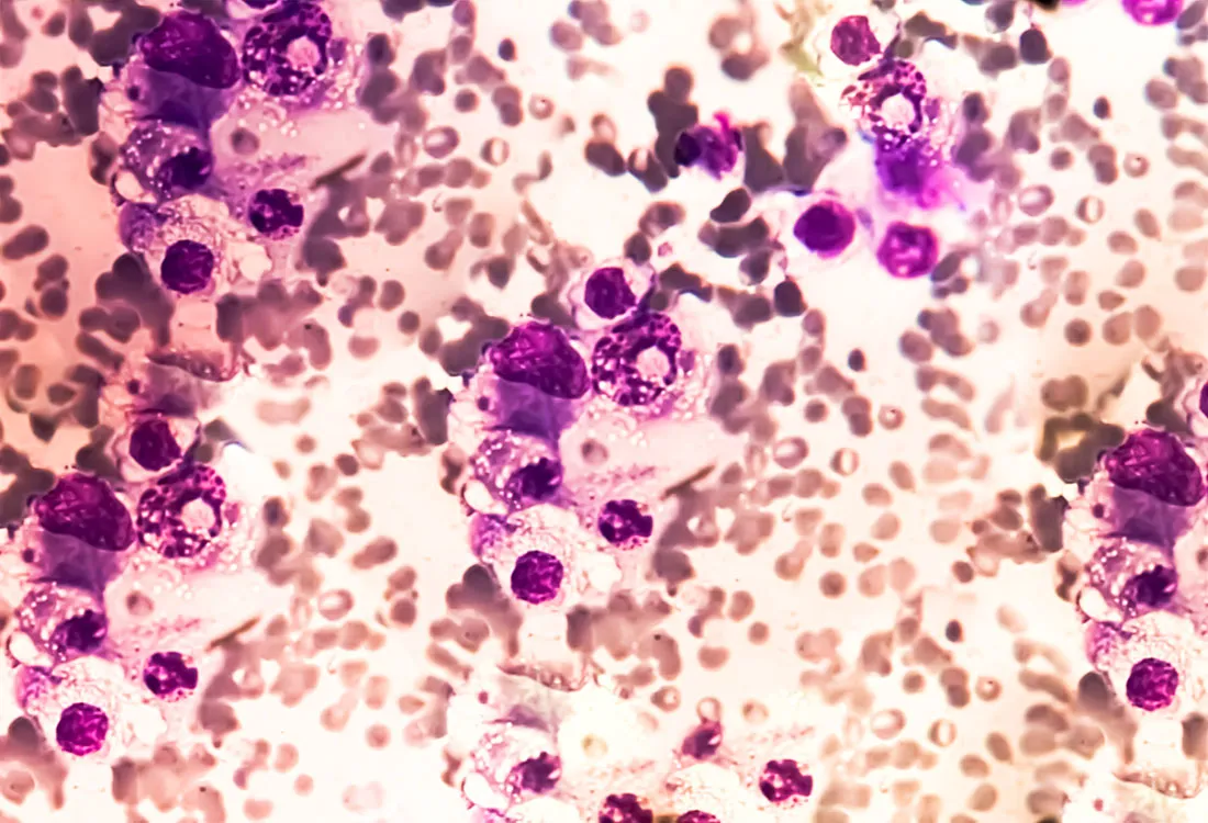 Antibody Therapy Eradicates Traces of Multiple Myeloma in Preliminary Trial