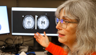 Mixed results in using lipoic acid to treat progressive multiple sclerosis