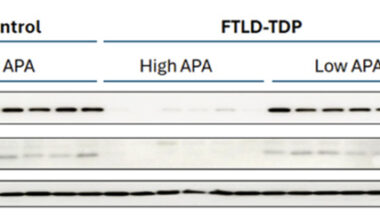 In TDP-43 Proteinopathy, Misplaced PolyA Tails Mean Crippled Retromers