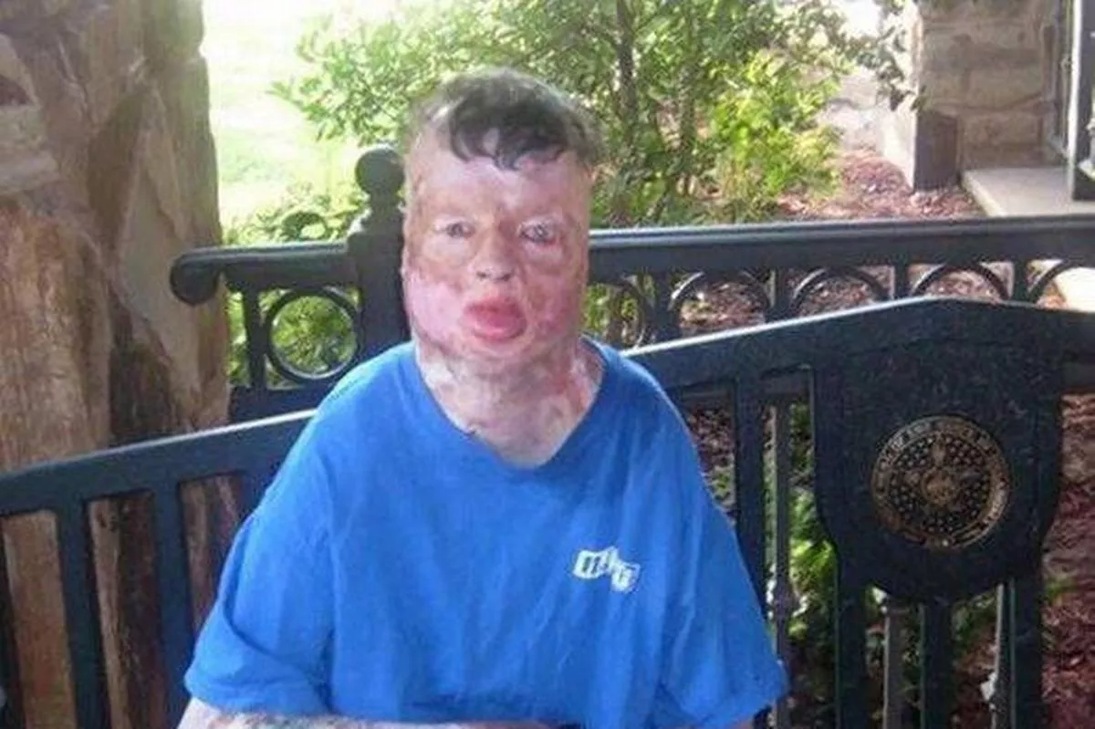 Robbie Middleton was eight years old when he was tied to a tree and set on fire, he developed skin cancer as a result of his injuries 