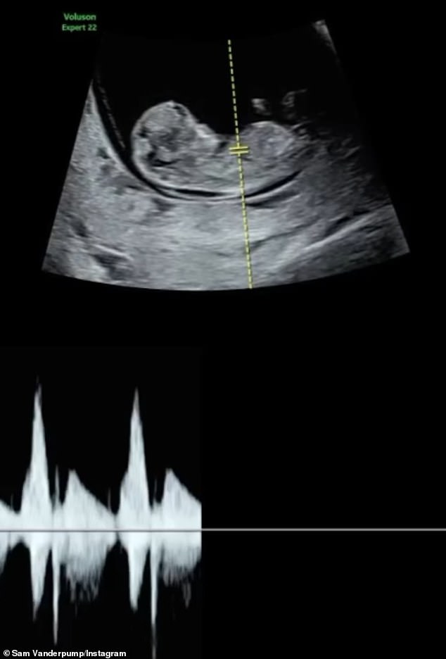 He also posted a glimpse of their sonogram