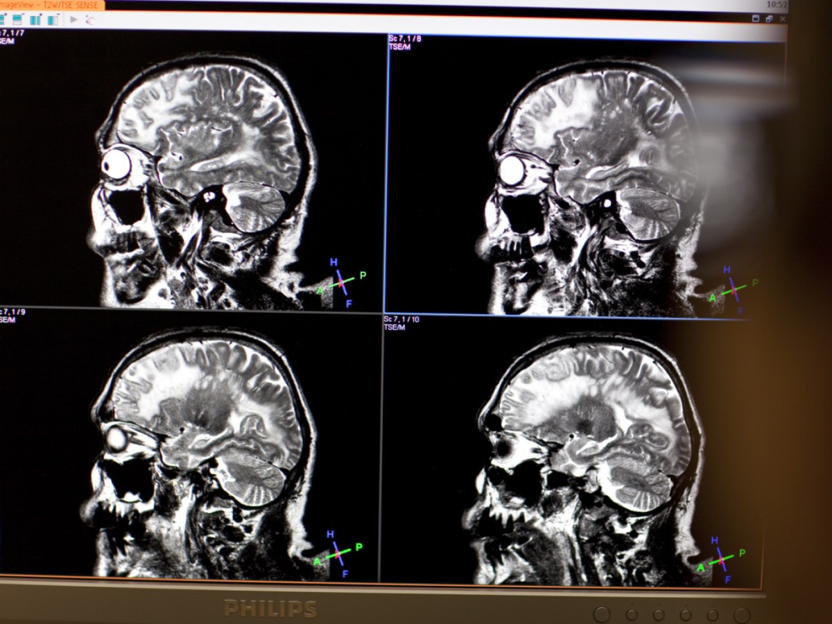 Geneva scientists find new approach for schizophrenia symptoms