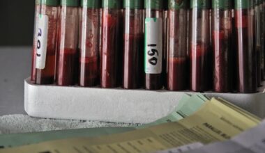 New study raises questions over TB testing during Covid