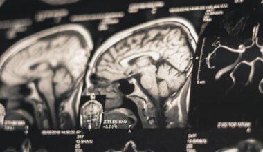 NIH study clearly ties risk of dementia to severe CTE