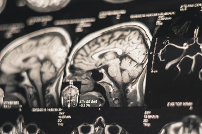 NIH study clearly ties risk of dementia to severe CTE