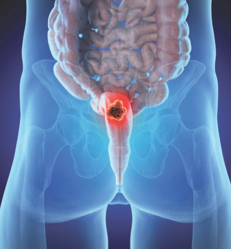 In patients less likely to respond to neoadjuvant chemoradiation, postoperative adjuvant therapy may be a viable strategy in this ESCC group.