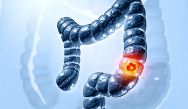 Study: Association of alcohol intake over the lifetime with colorectal adenoma and colorectal cancer risk in the Prostate, Lung, Colorectal, and Ovarian Cancer Screening Trial. Image Credit: crystal light / Shutterstock