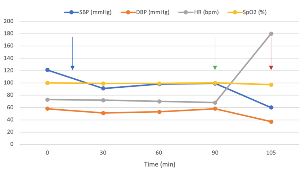 Perioperative Takotsubo Cardiomyopathy Revealed by Ventricular Arrhythmia After a Minor Surgery in a Young Woman