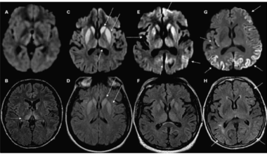 Rapidly Progressing Encephalopathy in a 49-Year-Old Female: Creutzfeldt-Jakob Disease