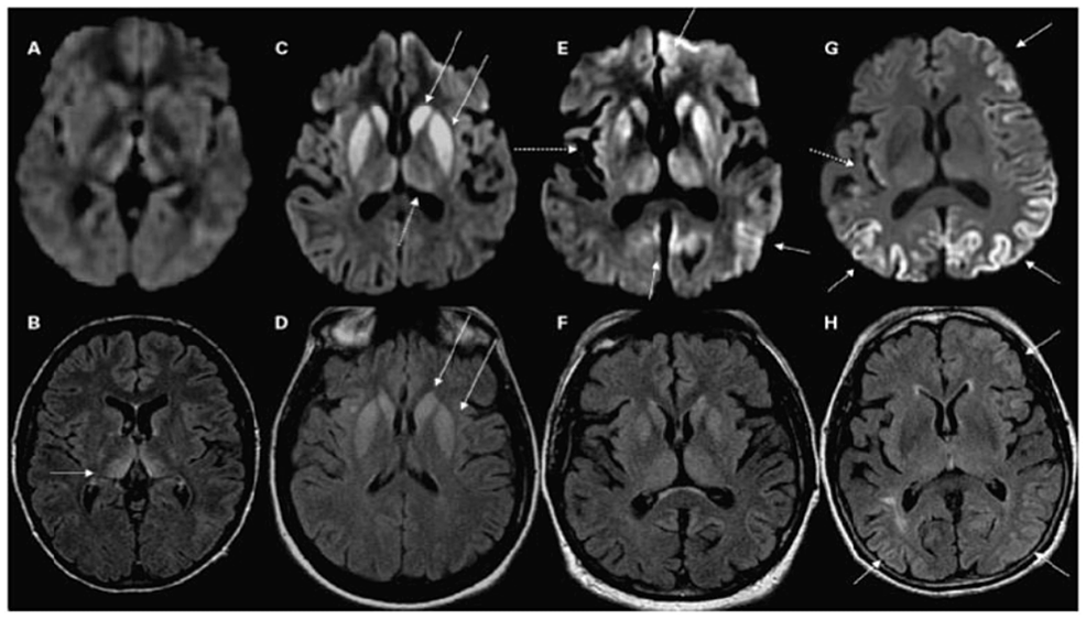 Rapidly Progressing Encephalopathy in a 49-Year-Old Female: Creutzfeldt-Jakob Disease