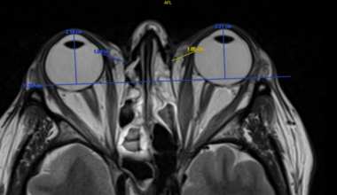 Quantitative Magnetic Resonance Imaging Biomarkers in the Evaluation of Disease Activity in Thyroid Eye Disease: A Retrospective Study