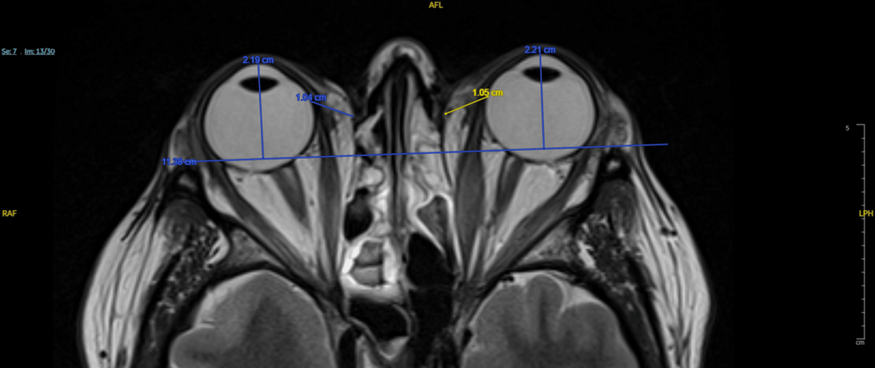Quantitative Magnetic Resonance Imaging Biomarkers in the Evaluation of Disease Activity in Thyroid Eye Disease: A Retrospective Study