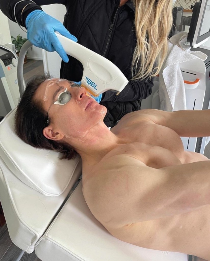 A man with eye protection undergoing a BBL laser treatment on his face.