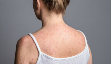 UK no longer considered to have eliminated measles