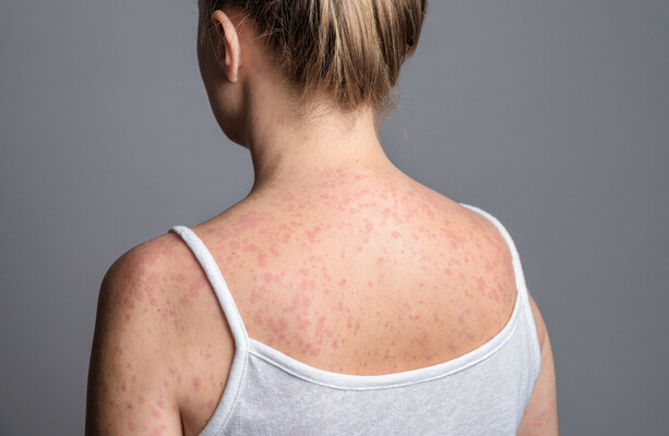 UK no longer considered to have eliminated measles