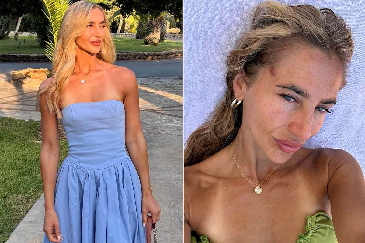 Woman Used Tanning Beds Weekly for 6 Years. At Age 22, She Mistook a Red Patch for Eczema, but It Was Skin Cancer