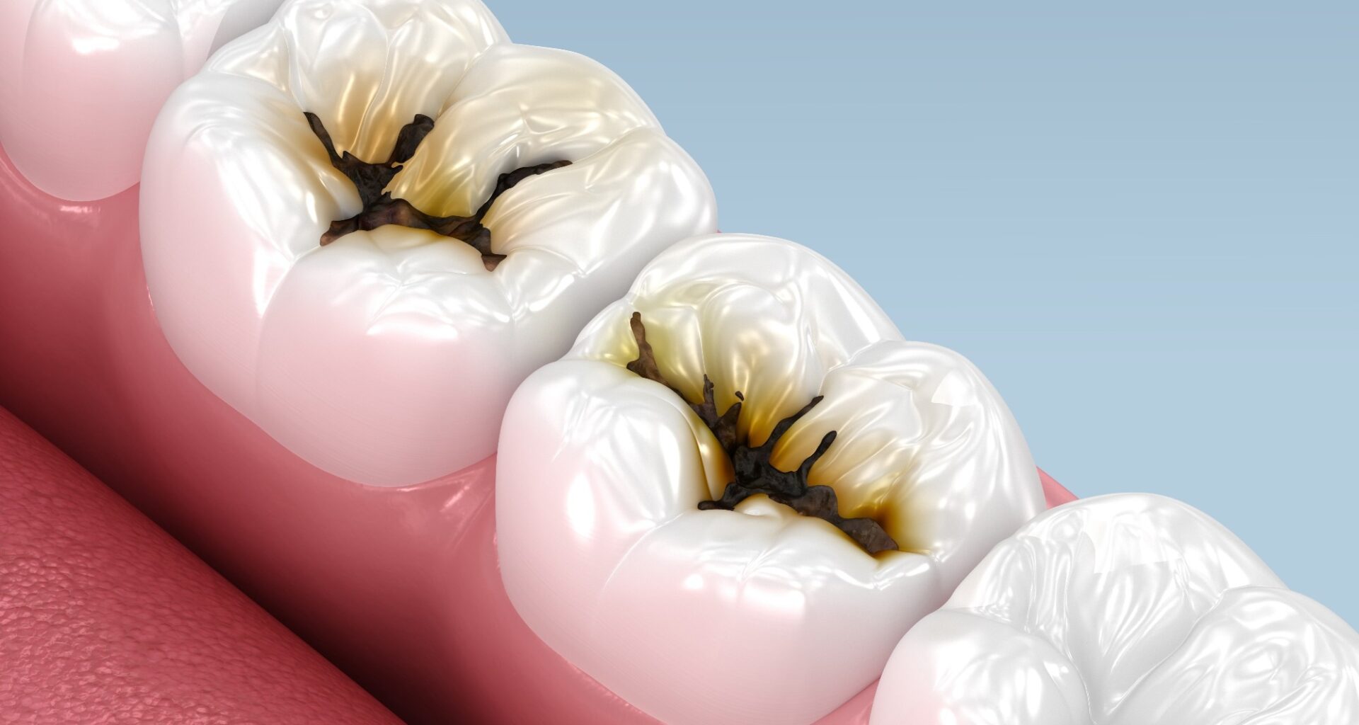 tudy: Efficacy of Silver Diamine Fluoride on Young Children With Severe Early Childhood Caries. Image Credit: Alex Mit / Shutterstock