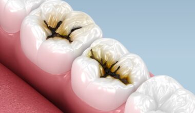 tudy: Efficacy of Silver Diamine Fluoride on Young Children With Severe Early Childhood Caries. Image Credit: Alex Mit / Shutterstock