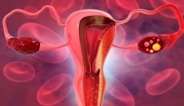 High antioxidant diet linked to lower risk of cervical cancer in women
