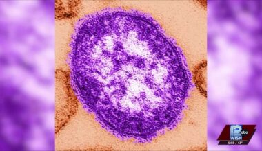 Measles cases surge to 15 in Iowa and Lafayette counties as Wisconsin warns of more spread