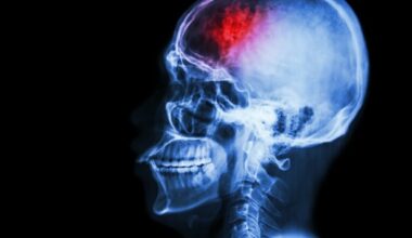 Early-onset epilepsy tied to lower academic achievement
