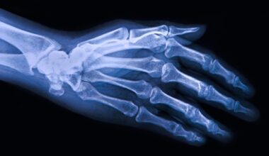 New review explores purinergic signaling pathways in osteoarthritis progression