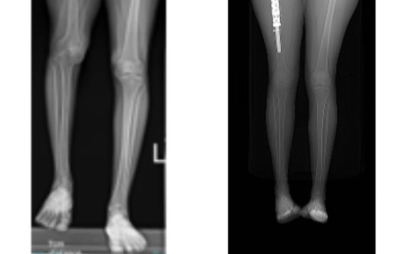 Israeli doctors use 3D printer to lengthen woman's leg for vanishing bone disease