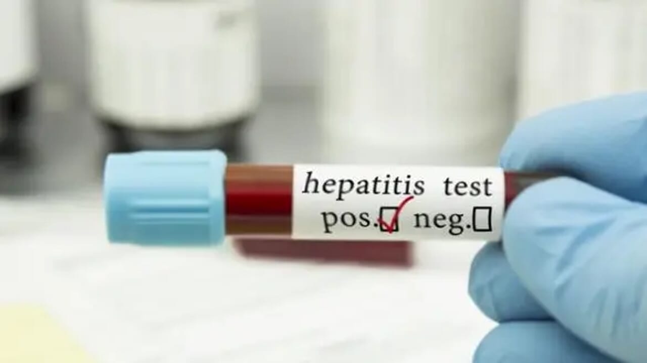 Screening regionale sull'epatite C, circa mille casi su mezzo milione di test
