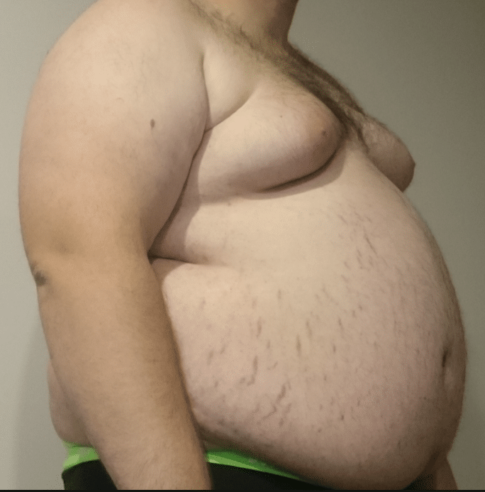 L'Umbria dice sì al riconoscimento dell'obesità come malattia cronica: «Impegno per riconoscimento Lea»