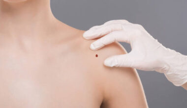 Mappatura dei nei non è sparita, 'è nella visita dermatologica' - Sanità
