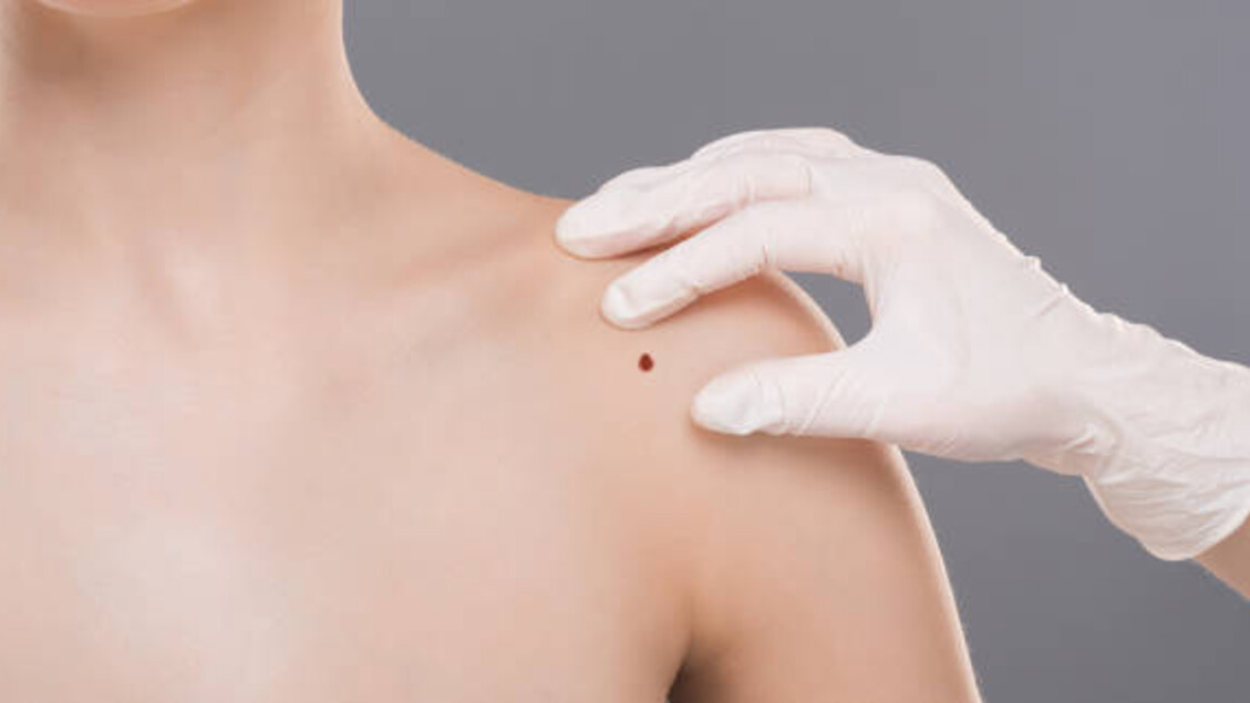 Mappatura dei nei non è sparita, 'è nella visita dermatologica' - Sanità
